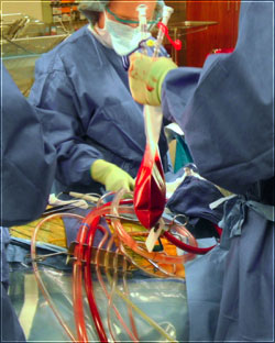 Hemobag system being used during a cardiac surgery procedure